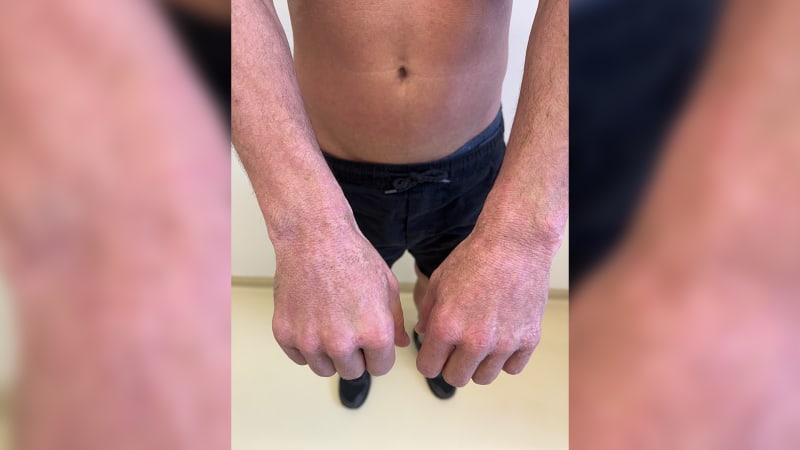 Atopický ekzém ničí lidem život, pacienti se drásají do krve. Mnozí se k léčbě nedostanou